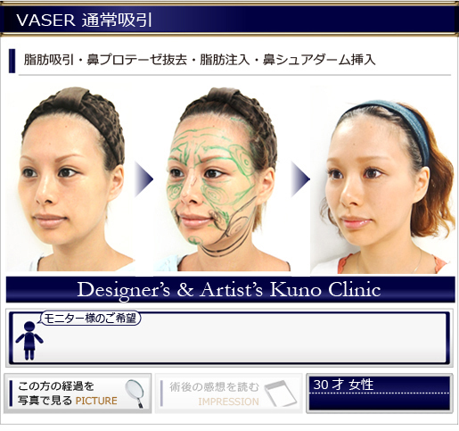VASER 通常吸引