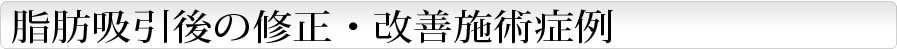 脂肪吸引後の修正・改善施術症例